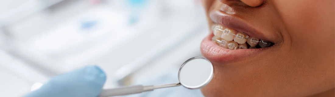 How to Brush Teeth With Braces in Thousand Oaks CA