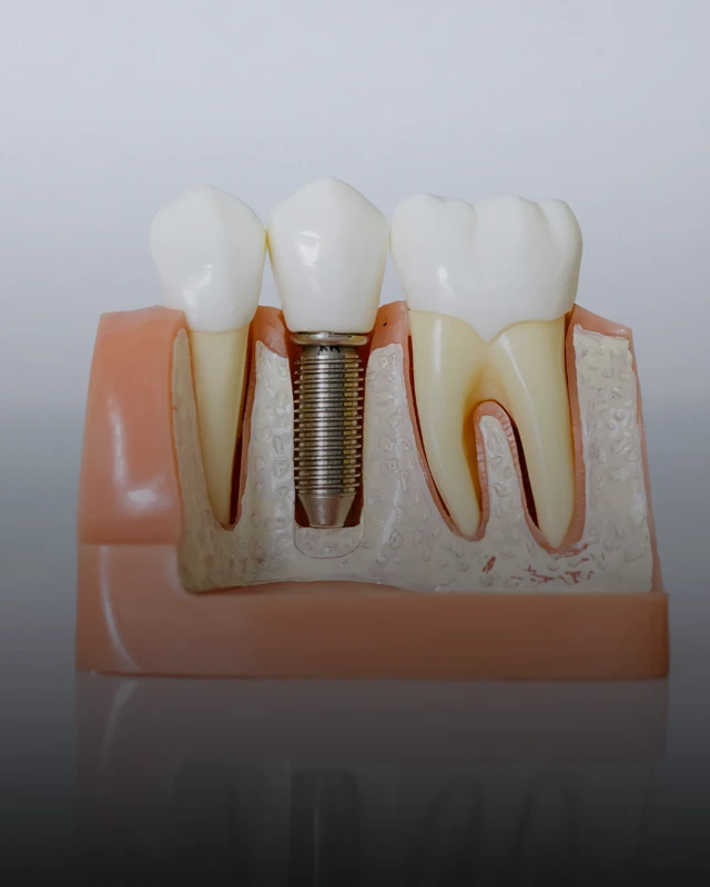 A model of a dental implant nestled between two natural teeth.